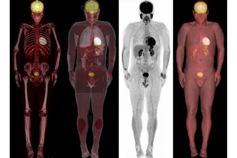 Vier medizinische Bilder zeigen den menschlichen Körper. Die PET/CT-Nachteile sind hier nicht ersichtlich, nur die Darstellung von Organen und Knochen.