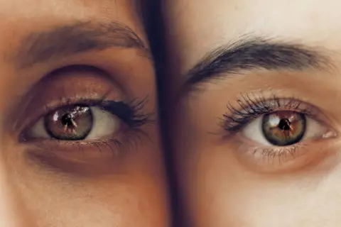 Dos ojos de cerca, uno con ojeras pigmentadas y el otro con piel clara. Reflejo de un fotógrafo en el iris.