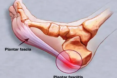 Illustration av fotens anatomi som visar plantar fascia och smärtsamma triggerpunkter vid plantar fasciitis.