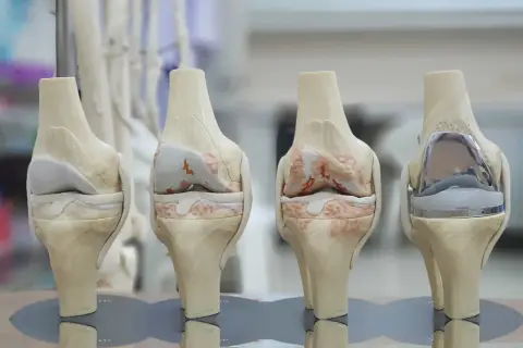 Modèles de genoux montrant l'évolution de l'arthrose et une prothèse. Ces images illustrent le succès de la prothèse du genou.