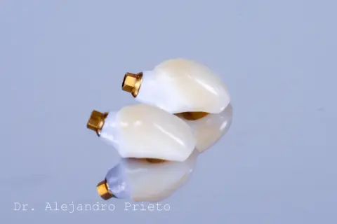 Dos coronas dentales con base dorada, reflejadas en una superficie pulida. La marca "Dr. Alejandro Prieto" sugiere que es el mejor especialista en implantes dentales.