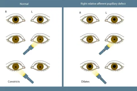 Ilustracja porównuje reakcję źrenic w oku normalnym i z prawostronnym deficytem aferentnym. Widoczna anizokoria, czyli nierówność źrenic, jest kluczowa w diagnostyce.