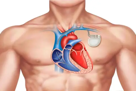 Anatomical illustration of a human chest showing a heart with a rozrusznik serca implanted.