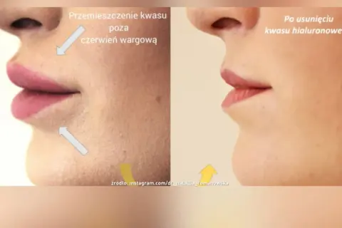 Przed i po usunięciu kwasu hialuronowego z ust. Pokazuje efekt powiększania ust metodą na płasko i jego cofnięcie.