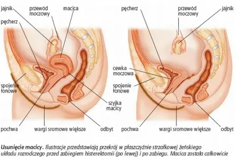 Histerektomia a miesiączka: Koniec okresu? Zrozum swoje ciało