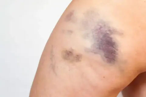 Große, schnell blaue Flecken auf dem Bein einer Frau nach einem Sturz.