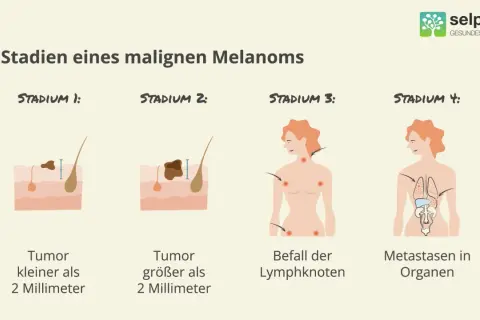 Illustrationen zeigen Stadien eines malignen Melanoms: Tumorgröße, Lymphknotenbefall und Metastasierung. Früherkennung ist wichtig für die schwarzer hautkrebs behandlung.