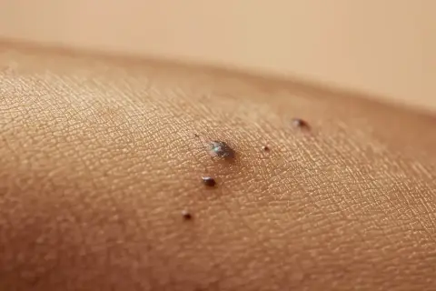 Zbliżenie na skórę z kilkoma ciemnymi znamionami, w tym jedna większa czarna kropka na ustach.
