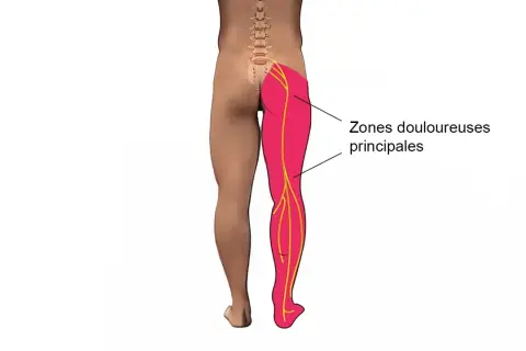 Schéma montrant les zones douloureuses principales d'une jambe, suggérant un mal aux cuisses la nuit.