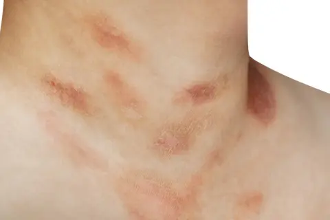 Hautirritationen am Hals, die wie ein pilzartiger Ausschlag aussehen, mit roten, schuppigen Flecken.