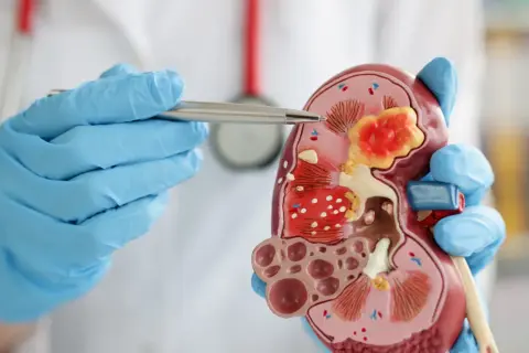 Lekarz w niebieskich rękawiczkach pokazuje model nerki z guzem, sugerując podwyższona kreatynina.