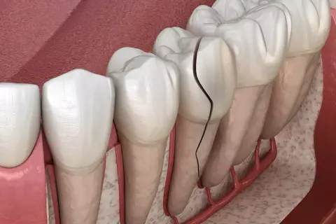 Dientes delanteros con grietas visibles, mostrando el daño en el esmalte y la pulpa.