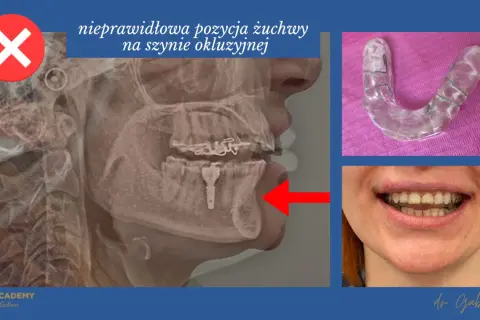 Rentgen żuchwy z nieprawidłową pozycją, szyna relaksacyjna twarda. Czerwony X oznacza błąd.