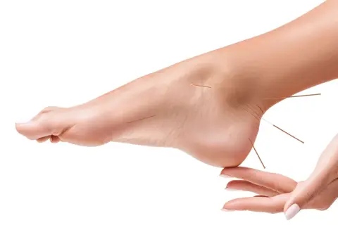 Acupuncture sur le pied pour soulager la douleur. Des aiguilles fines sont insérées sur le dessus et le talon du pied.