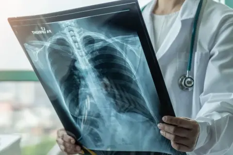 Lekarz analizuje RTG klatki piersiowej, szukając oznak odmy płucnej. Czy można umrzeć? Szybka diagnoza ratuje życie.