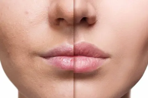 Comparación de piel antes y después, mostrando un aumento de labios y piel más lisa y uniforme.