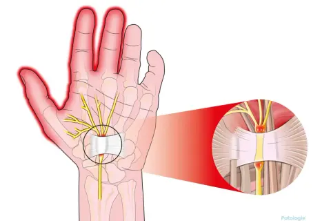 Illustrazione anatomica del tunnel carpale con nervo compresso, causa di scosse alle mani.