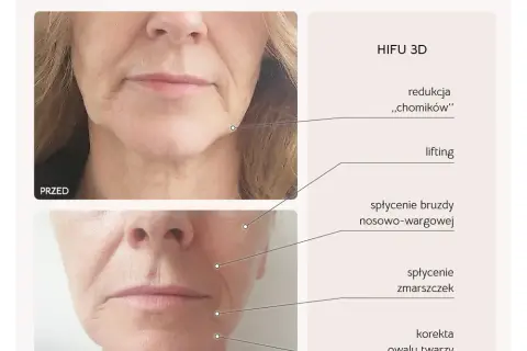 Zabiegi na szyję po 50.: HIFU, RF, stymulatory co wybrać?