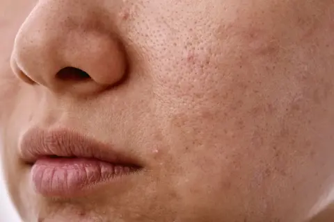 Widoczne pory skóry i drobne niedoskonałości, które mogą być związane z nadmierną produkcją sebum.