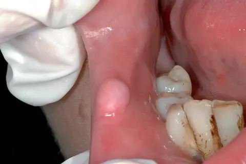 Guancia interna con gonfiore, forse dovuto a un morso. Denti visibili.
