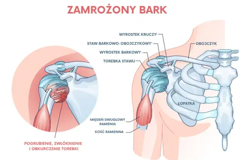 Ilustracja przedstawia anatomię barku z zaznaczonym pogrubieniem, zwłóknieniem i obkurczeniem torebki stawu, co jest charakterystyczne dla zespołu szyjno barkowego.