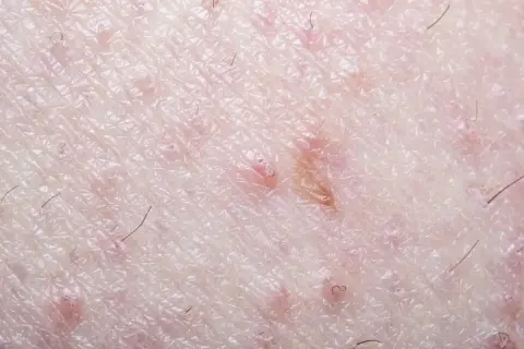 Gros plan sur la peau du pubis, montrant des rougeurs et des poils incarnés, signe d'une irritation cutanée.