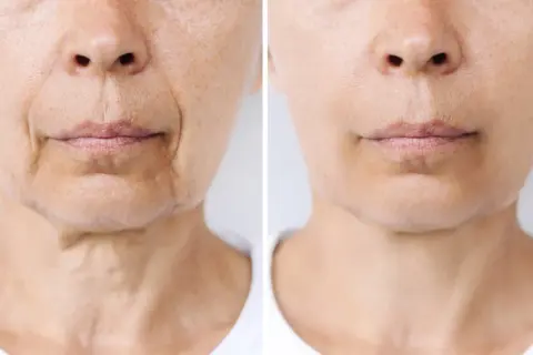 Comparación de piel: antes y después de un tratamiento que podría afectar el "ozempic face", mostrando reducción de arrugas y flacidez.