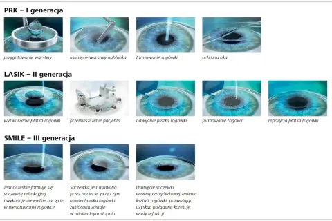 Ilustracje pokazują etapy korekcji wzroku laserem: PRK, LASIK i SMILE. Każda metoda poprawia widzenie.