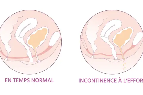 Schéma comparant le périnée féminin normal et en cas d'incontinence à l'effort. L'irritation périnée femme peut être liée à ces fuites.