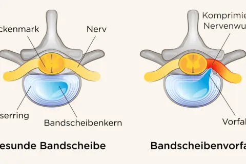 Vergleich gesunde Bandscheibe vs. Bandscheibenvorfall. Ein Vorfall drückt auf Nerven, was zu quälenden Bandscheibenvorfall Schmerzen gehen nicht weg führen kann.