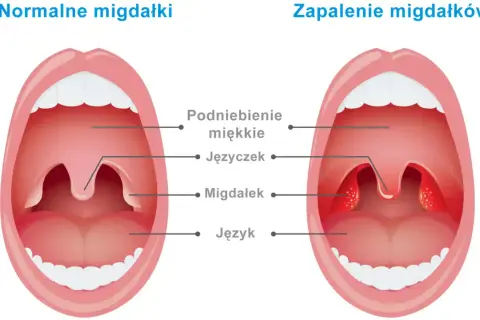 Migdałki NFZ: Jak skrócić kolejkę? Znajdź termin w kilka dni!