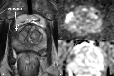 MRT Prostata Befund verstehen: Bild a zeigt eine Läsion mit PI-RADS 4. Bilder b und c zeigen die Diffusionsbildgebung, die bei der Interpretation hilft.