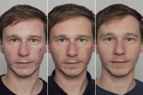 Jak przyspieszyć gojenie po laserze frakcyjnym? Skuteczne porady