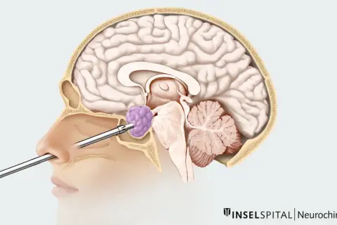 Chirurgischer Eingriff durch die Nase zur Entfernung eines Hypophysentumors.