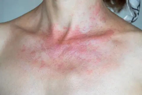 Rote, juckende Haut am Dekolleté und Hals, ein Zeichen für Sonnenallergie. Vorbeugen ist wichtig.