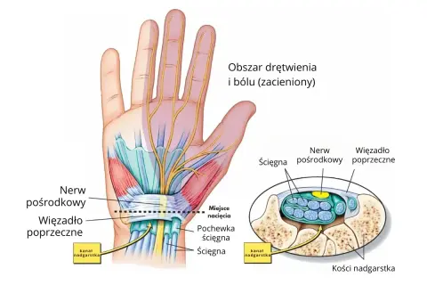 Anatomia dłoni i nadgarstka, pokazująca nerw pośrodkowy i ścięgna w kanale nadgarstka, obszar drętwienia i bólu.