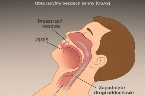Bezdech senny: Jak rozpoznać, leczyć i dostać refundację CPAP?