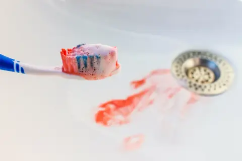 Szczoteczka do zębów z pianą i śladami krwi w umywalce. Krwawiące dziąsła to sygnał, by udać się do dentysty.