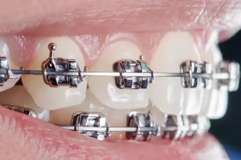 Zbliżenie na zęby z aparatem ortodontycznym. Metalowe zamki i łuk widoczne na zębach, świadczące o leczeniu u dentysty.
