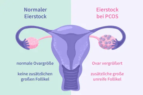 Porównanie jajnika: normalny vs. przy PCOS. Przy PCOS jajnik jest powiększony, z licznymi niedojrzałymi pęcherzykami.