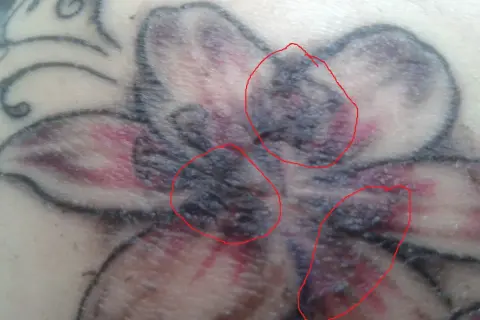 Nahaufnahme eines verheilenden Tattoos einer Blume. Rote Kreise markieren Bereiche mit Krustenbildung, die auf die tattoo kruste hinweisen.