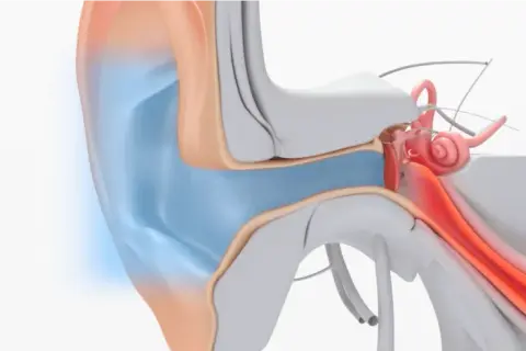 Illustration av örats anatomi, visar hur man kan ta bort vaxpropp för att återställa hörseln.