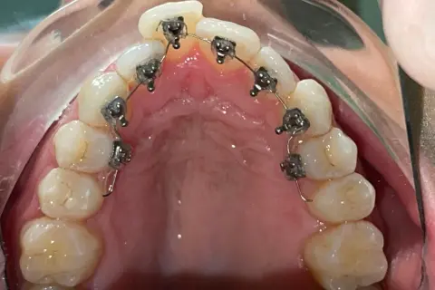 Apparecchio linguale: recensioni positive per questo trattamento ortodontico discreto.