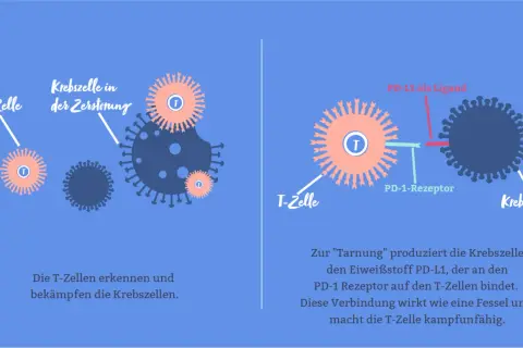 Immuntherapie bei Brustkrebs: T-Zellen bekämpfen Krebszellen, die sich durch PD-L1 tarnen.