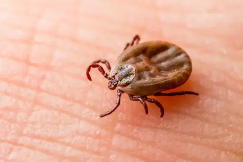 Kleszcz na skórze, potencjalne źródło choroby z Lyme.