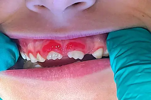 Zapalenie dziąseł u dziecka: Objawy, leczenie, kiedy do dentysty?