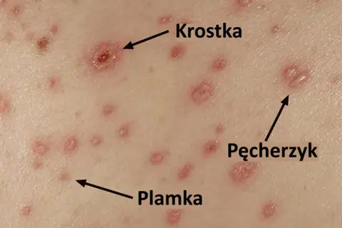 Początek ospy: widoczne plamki, krostki i pęcherzyki na skórze.