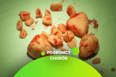 Kamienie w pęcherzu moczowym, usunięte podczas zabiegu.
