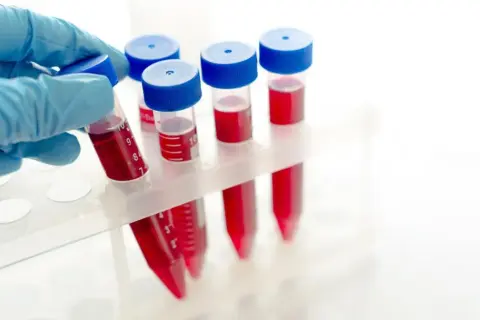 Rękawiczka pobiera probówkę z krwią. W stojaku widać więcej próbek, sugerując, że wyniki badań, np. **pdw podwyższone**, mogą wymagać dalszej analizy.