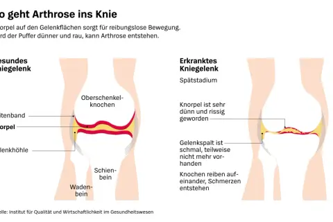 Vergleich von gesundem und arthrosekrankem Kniegelenk. Die Darstellung zeigt, wie Knorpelverschleiß zu Schmerzen führt – eine mögliche "wunderwaffe gegen arthrose knie" wäre hier wünschenswert.